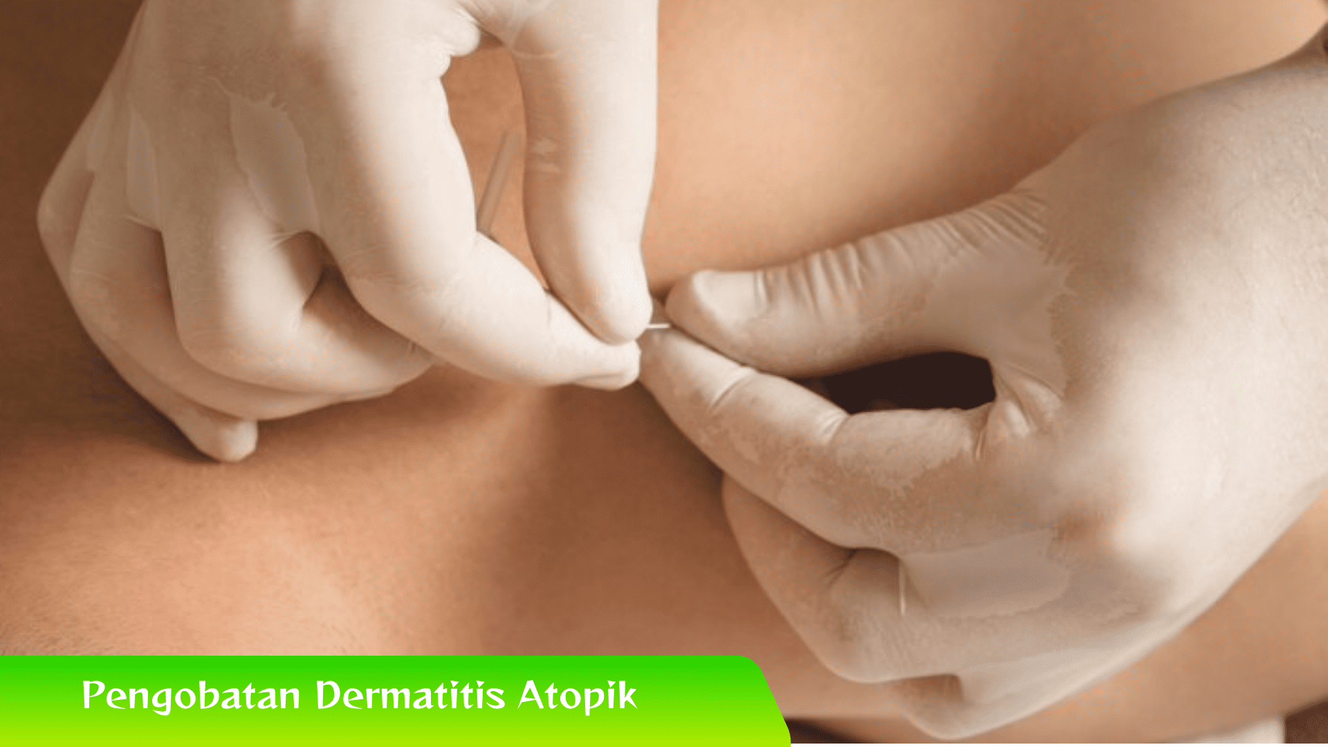 Pengobatan Dermatitis Atopik dan Gejalanya