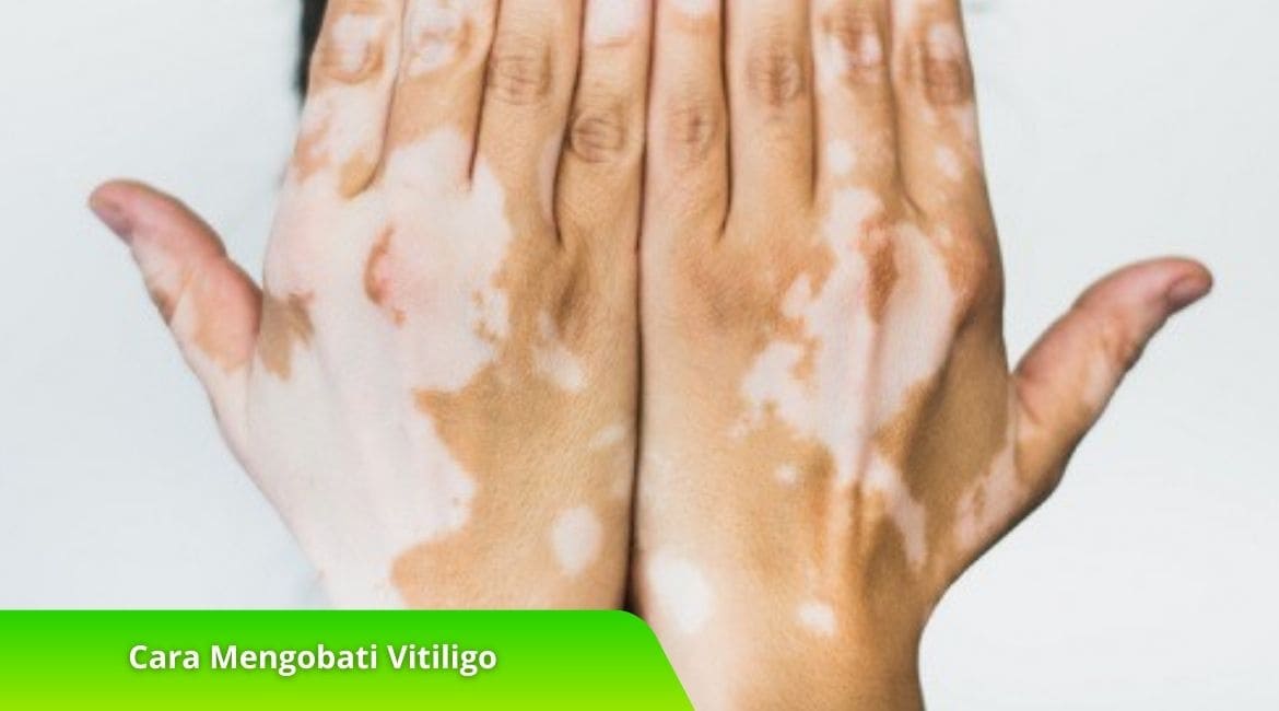 Cara Mengobati Vitiligo dengan Bahan Alami, Cek Disini!