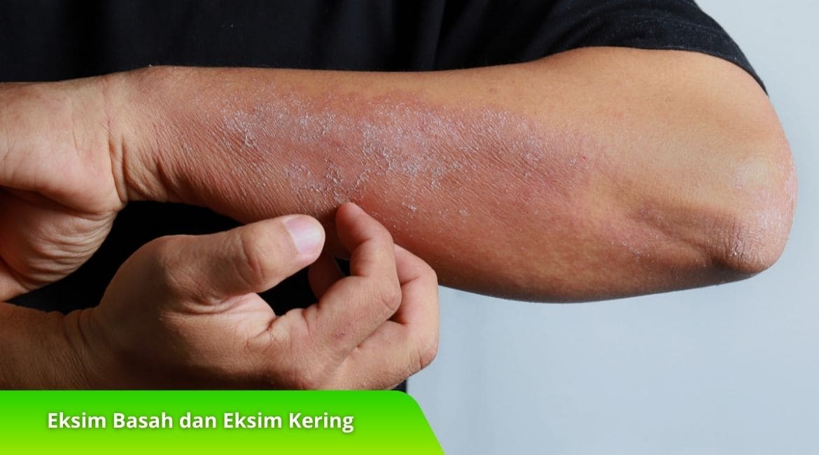 Eksim Basah dan Eksim Kering: Mana yang Lebih Berbahaya?