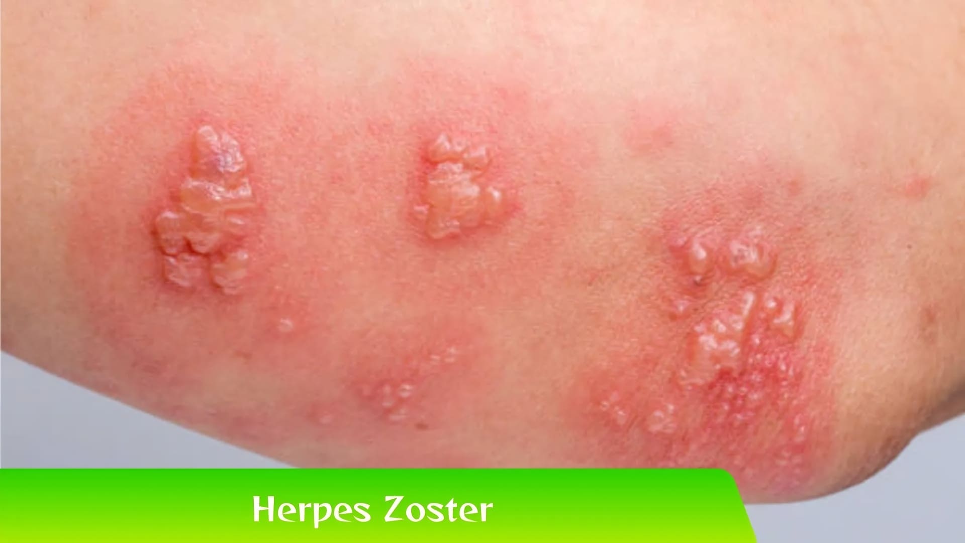 Pengertian Herpes Zoster dan Mengapa Bisa Terjadi?