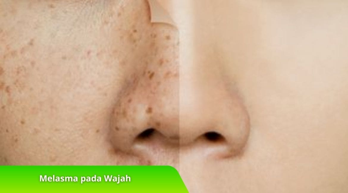 Melasma pada Wajah: Penyebab, Gejala dan Solusinya