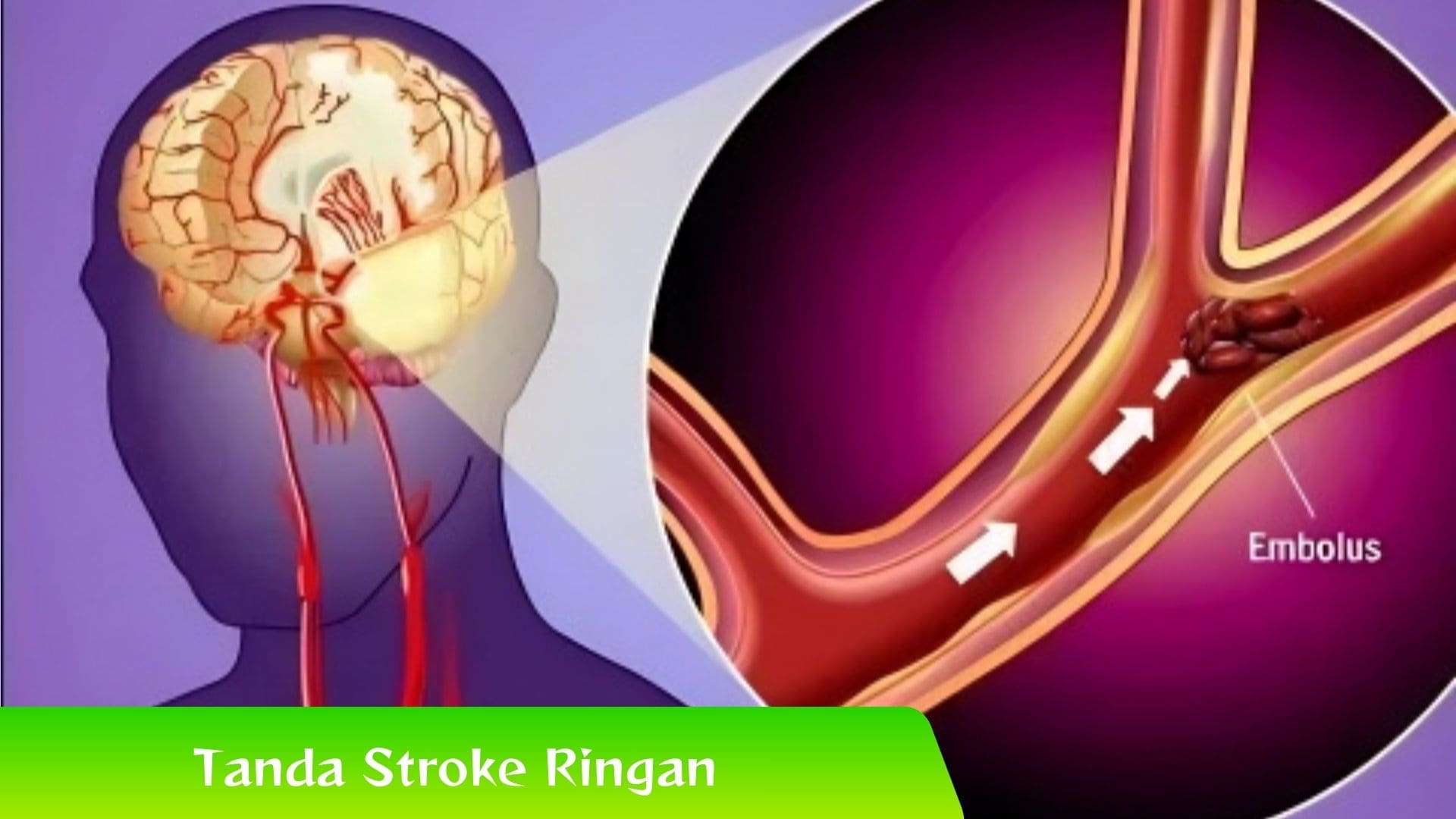 Inilah 7 Tanda Awal Stroke Ringan, Waspada Ya!