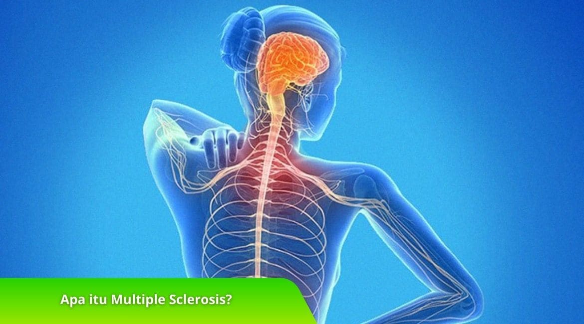 Apa itu Multiple Sclerosis? Kenali Penyebab dan Gejalanya Disini!