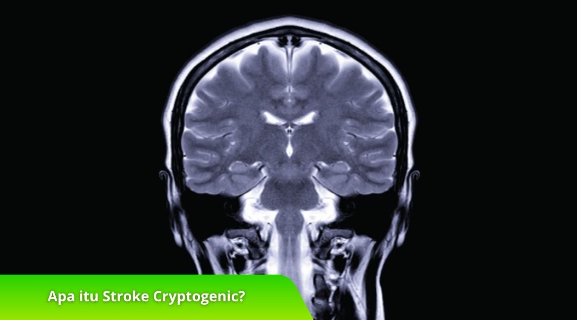 Apa itu Stroke Cryptogenic dan Bagaimana Mencegahnya Apa itu Stroke Cryptogenic dan Bagaimana Mencegahnya?