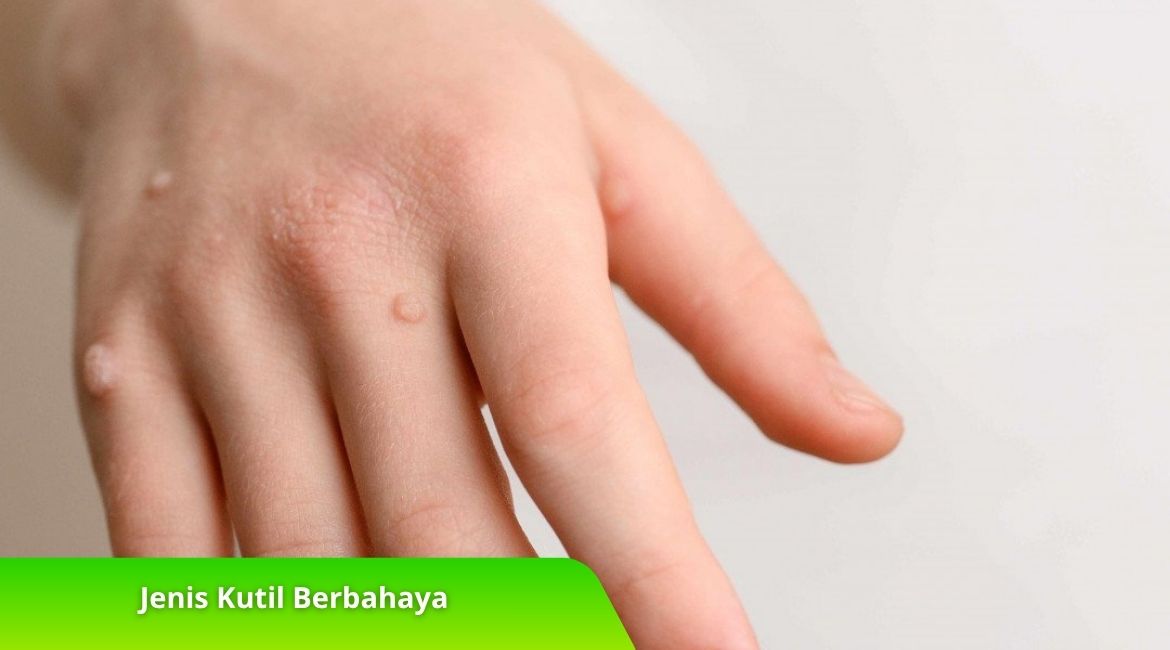 Waspadai 5 Jenis Kutil Berbahaya yang Bisa Sebabkan Komplikasi Waspadai 5 Jenis Kutil Berbahaya yang Bisa Sebabkan Komplikasi