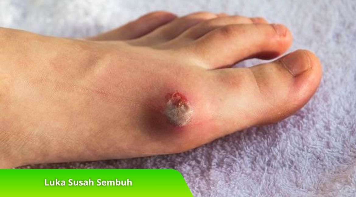 Diabetes dan Luka Susah Sembuh Ini Tips Perawatannya! Diabetes dan Luka Susah Sembuh? Ini Tips Perawatannya!
