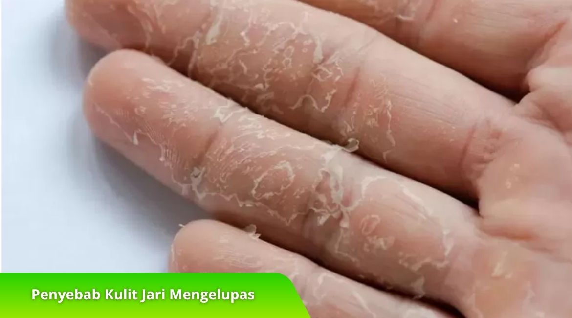 Kenali Penyebab Kulit Jari Mengelupas dan Solusinya di Sini! Kenali Penyebab Kulit Jari Mengelupas dan Solusinya di Sini!