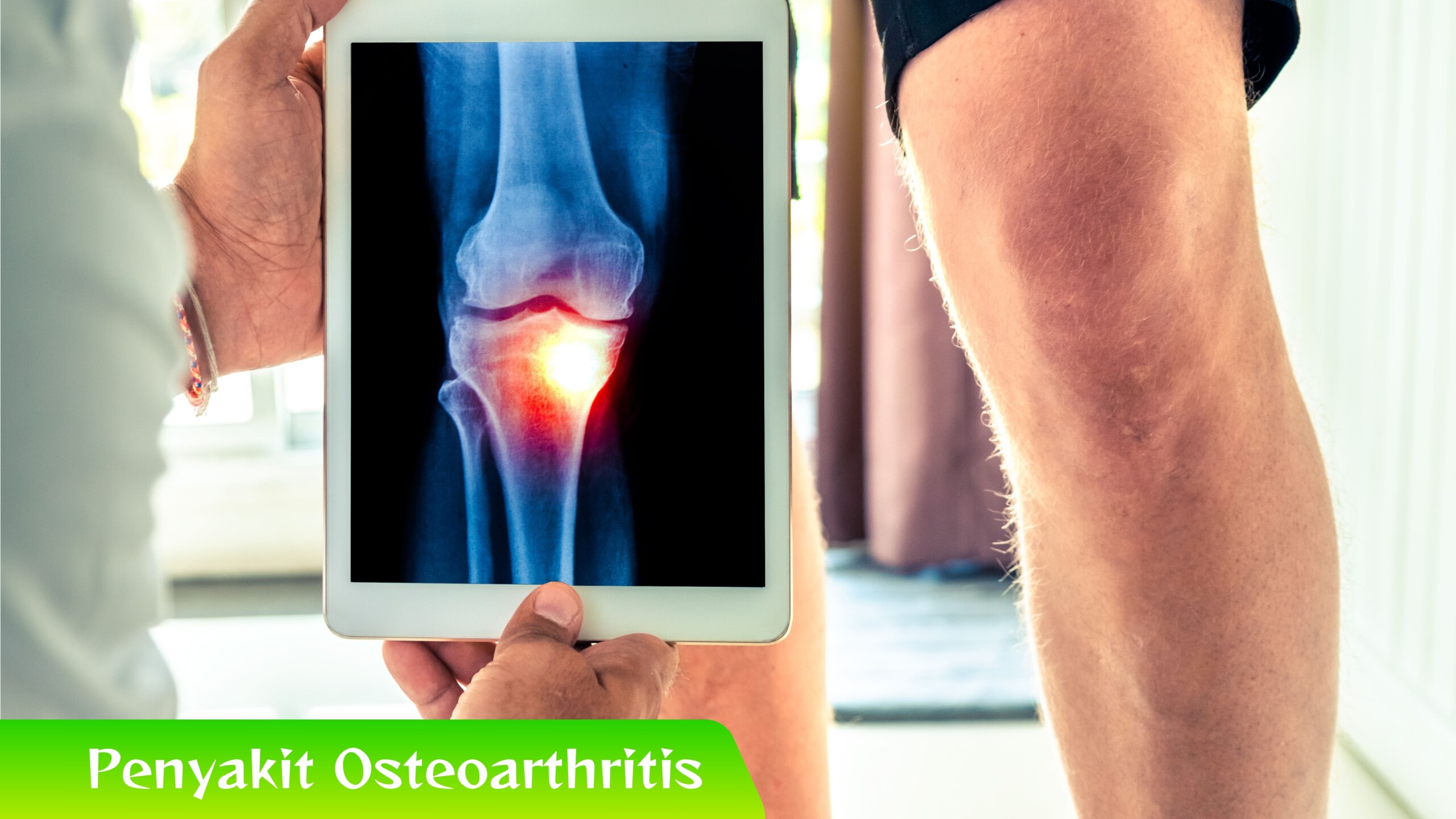 Penyakit Osteoarthritis Waspadai Gejala Awal Penyakit Osteoarthritis