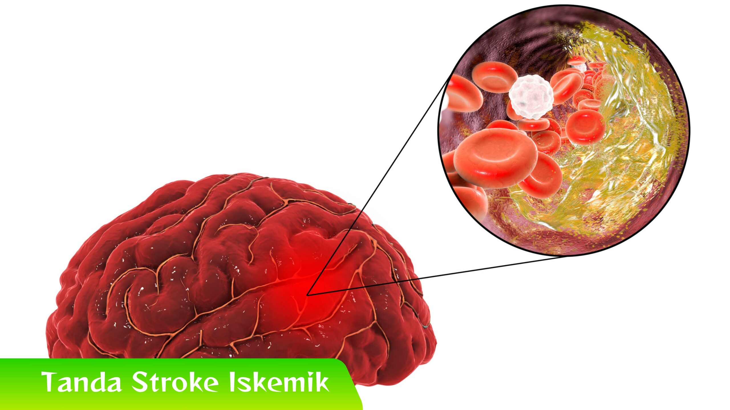 Tanda Stroke Iskemik Tanda Stroke Iskemik yang Muncul Diam-Diam
