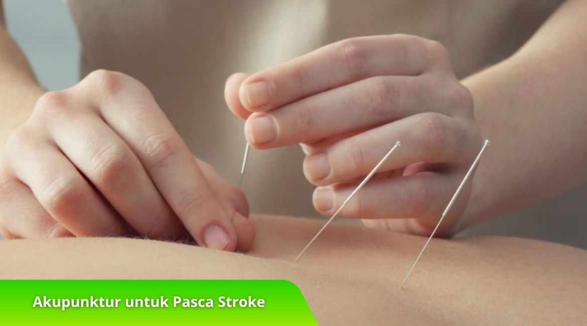 Terapi Akupunktur untuk Pasca Stroke, Efektifkah Terapi Akupunktur untuk Pasca Stroke, Efektifkah?