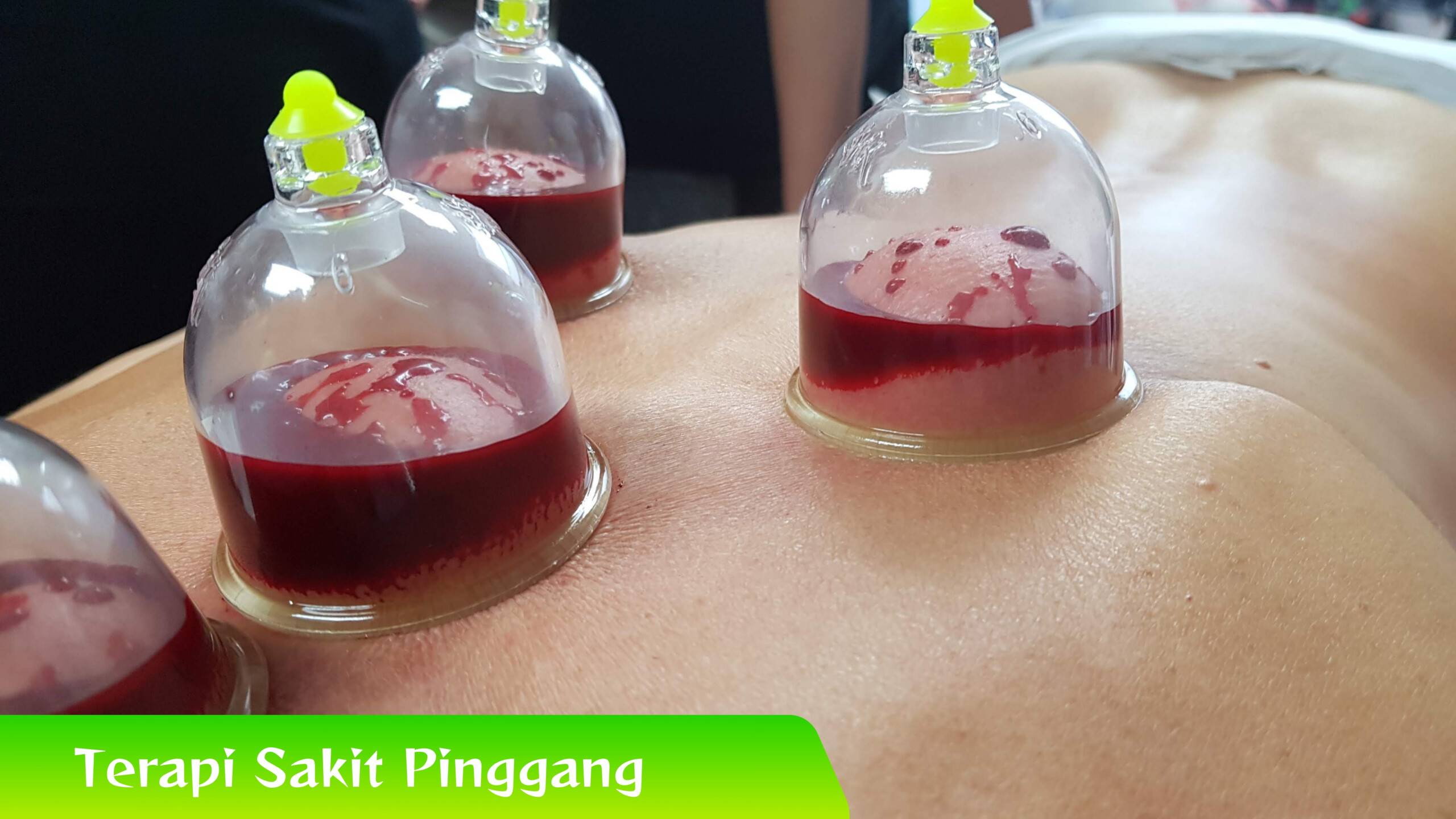 Inilah 4 Teknik TCM yang Ampuh untuk Terapi Sakit Pinggang