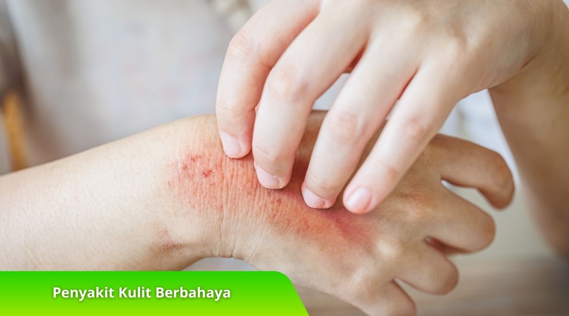 Waspada! Inilah Penyakit Kulit Berbahaya yang Perlu Anda Ketahui Waspada! Inilah Penyakit Kulit Berbahaya yang Perlu Anda Ketahui