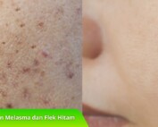 Ketahui Perbedaan Melasma dan Flek Hitam untuk Kulit Lebih Sehat