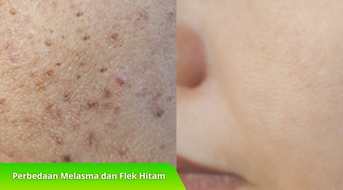 Ketahui Perbedaan Melasma dan Flek Hitam untuk Kulit Lebih Sehat